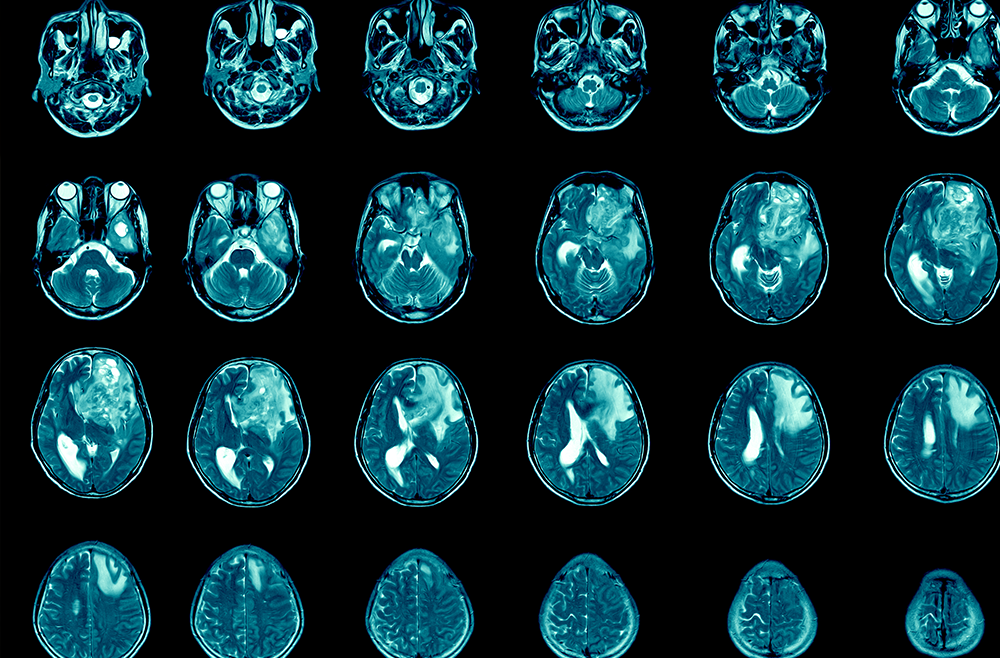 AI Enables the Largest Brain Tumor Study To-Date
